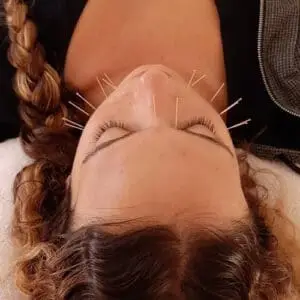 דיקור קוסמטי