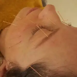 דיקור קוסמטי