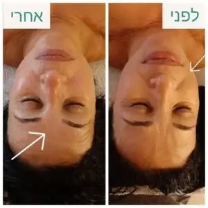 דיקור קוסמטי