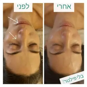 דיקור קוסמטי
