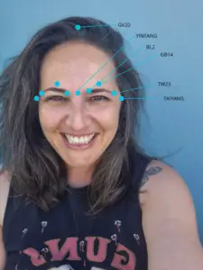נקודות דיקור בראש