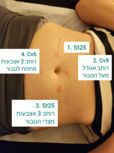 דיקור סביב הטבור
