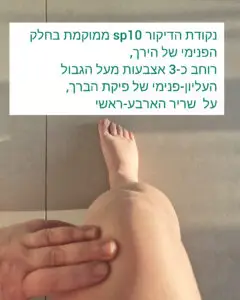 נקודת דיקור SP10