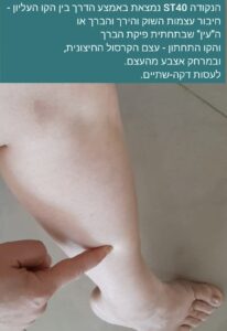 נקודת דיקור ST40