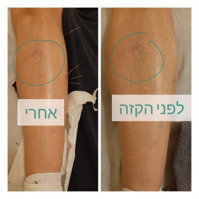 דיקור קוסמטי לורידים