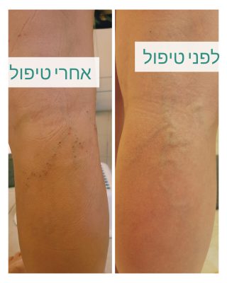 דיקור קוסמטי לורידים