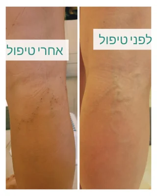 דיקור קוסמטי לורידים