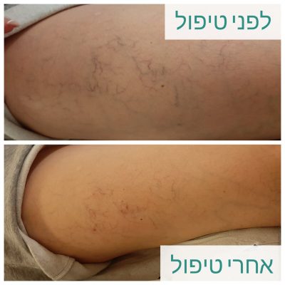 דיקור קוסמטי לורידים