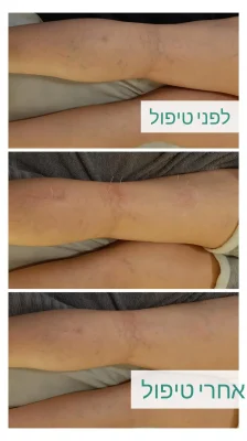 דיקור קוסמטי לורידים