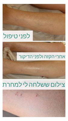 דיקור קוסמטי לורידים