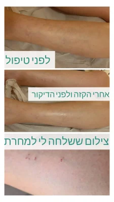 דיקור קוסמטי לורידים
