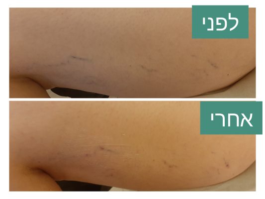 דיקור קוסמטי לורידים