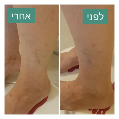 דיקור קוסמטי לורידים