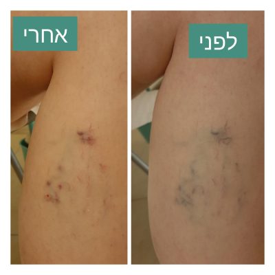 דיקור קוסמטי לורידים