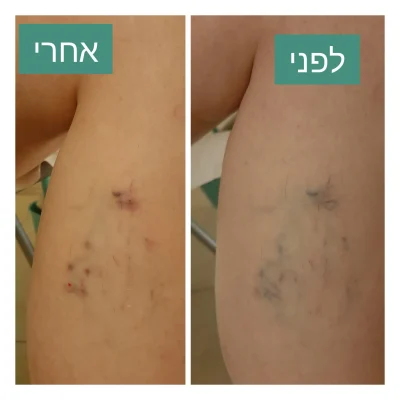 דיקור קוסמטי לורידים